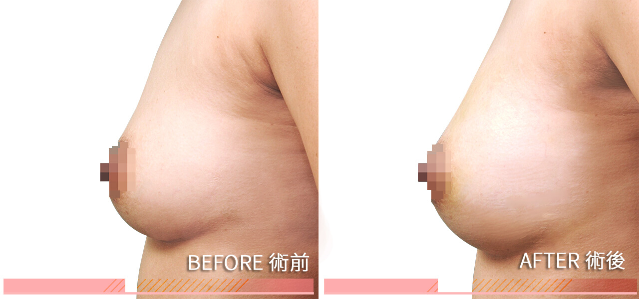 breast-honeymoon-before-after-case-1-1