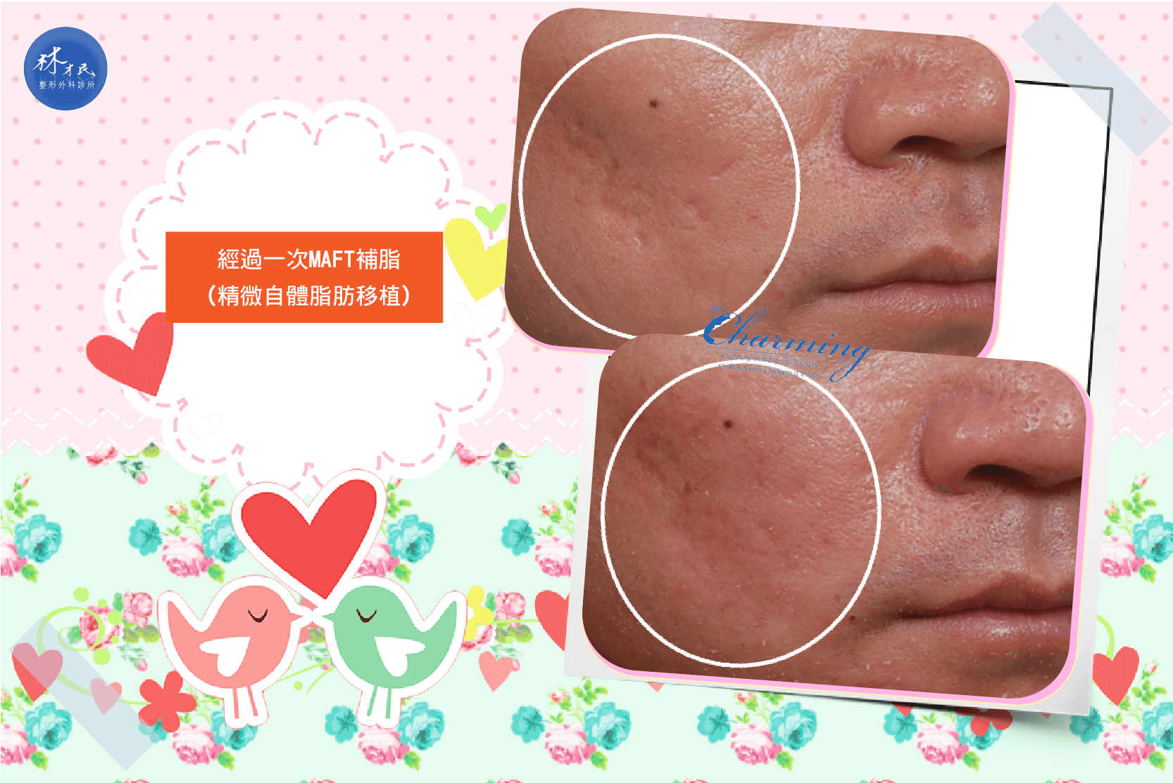 凹疤案例--高雄皮膚管理,台南皮膚管理,韓式皮膚管理-羚的肌膚