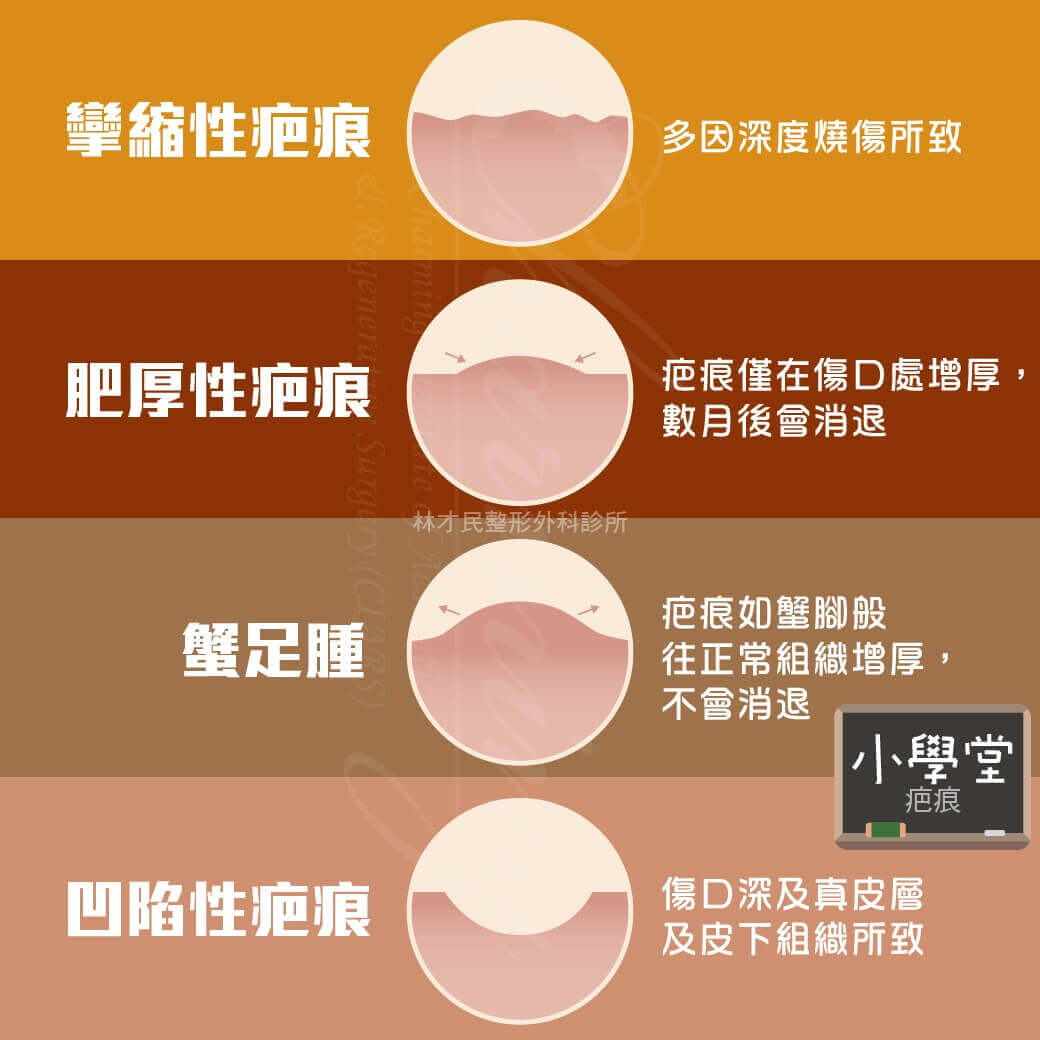 【小學堂】醫學知識 疤痕 | 林才民整形外科診所CIARS