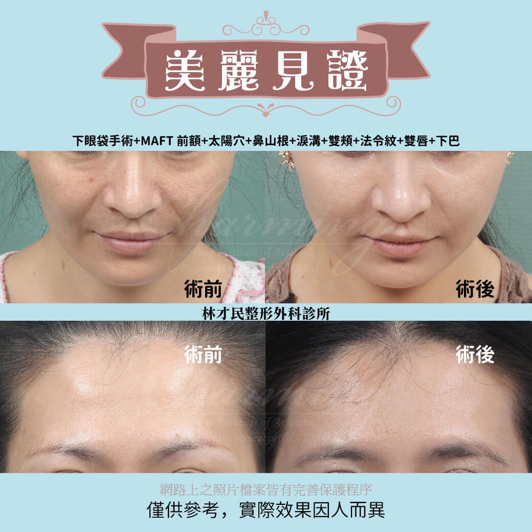 美麗見證 超自然der全臉補脂 林才民整形外科診所ciars
