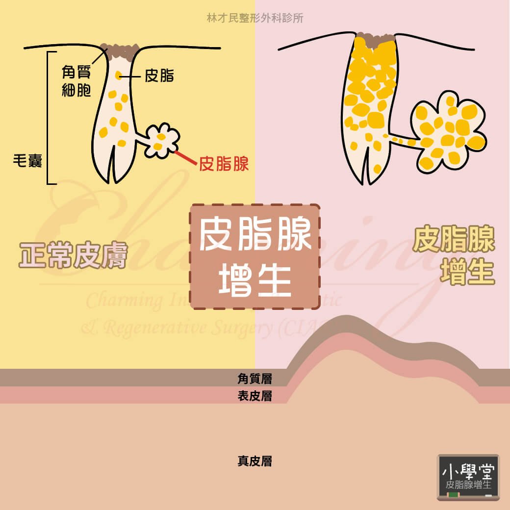 【小學堂】皮脂腺增生 | 林才民整形外科診所CIARS
