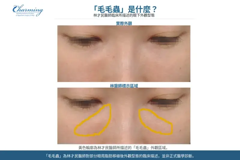 眼周脂肪移植後「毛毛蟲」外觀型態，林才民醫師標示眼下不規則外觀區域