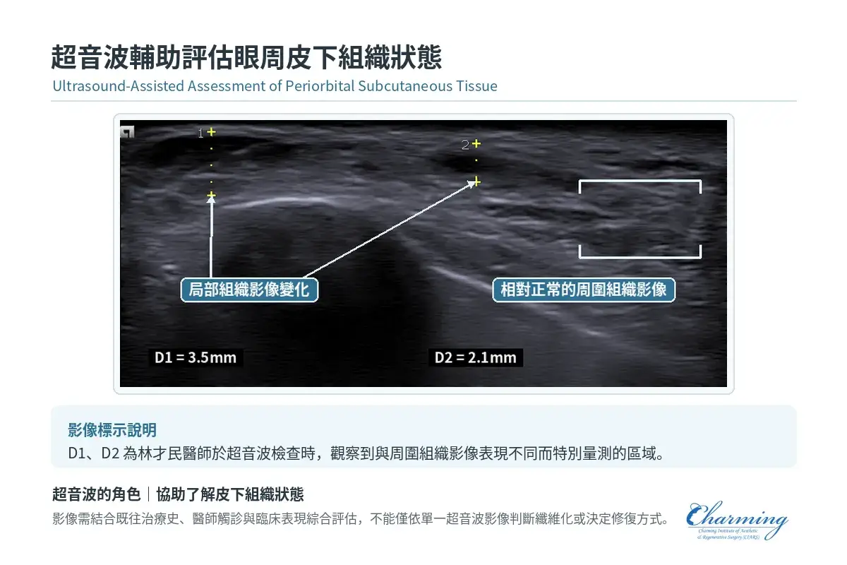 眼周超音波影像顯示 D1、D2 局部組織影像變化與相對正常的周圍組織影像,作為林才民醫師評估眼周皮下組織狀態的輔助資訊