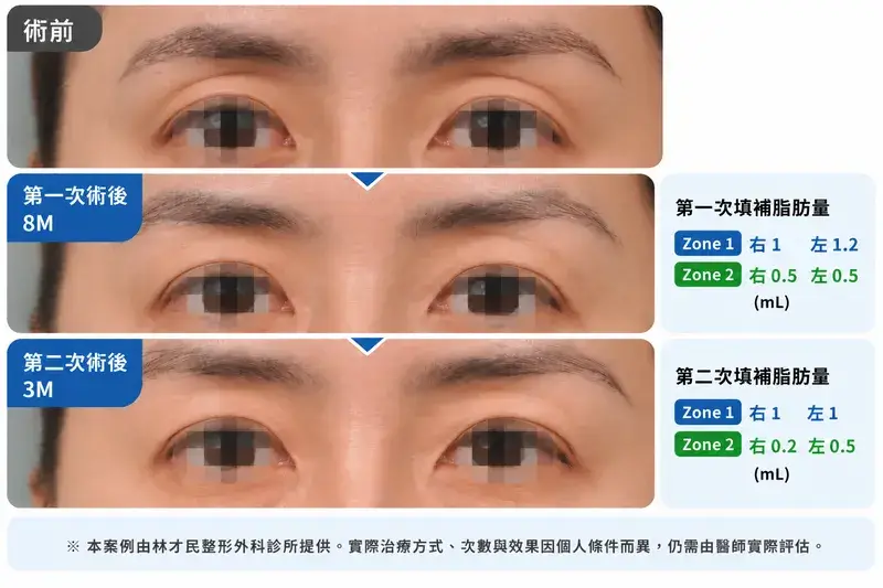 嚴重上眼窩凹陷分兩次脂肪移植案例，呈現術前、第一次術後8個月及第二次術後3個月的上眼窩變化