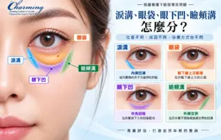 淚溝、眼袋、眼下凹與瞼頰溝位置比較圖，說明四種常見下眼區問題的差異