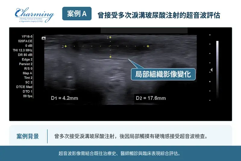 案例 A：曾多次接受淚溝玻尿酸注射，後因局部硬塊感接受超音波評估