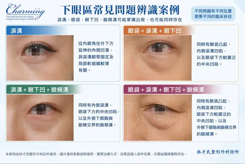 下眼區常見問題案例比較，呈現淚溝、眼袋、眼下凹與瞼頰溝單獨或同時存在的外觀差異