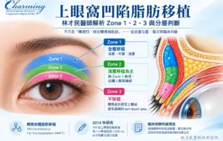 上眼窩凹陷脂肪移植示意圖，呈現 Zone 1、Zone 2、Zone 3 分區與脂肪放置層次
