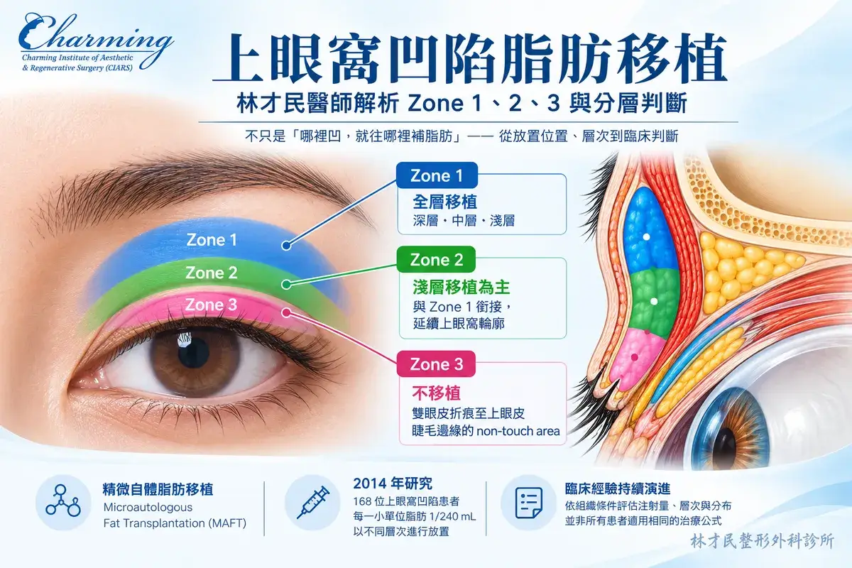 上眼窩凹陷脂肪移植示意圖，呈現 Zone 1、Zone 2、Zone 3 分區與脂肪放置層次