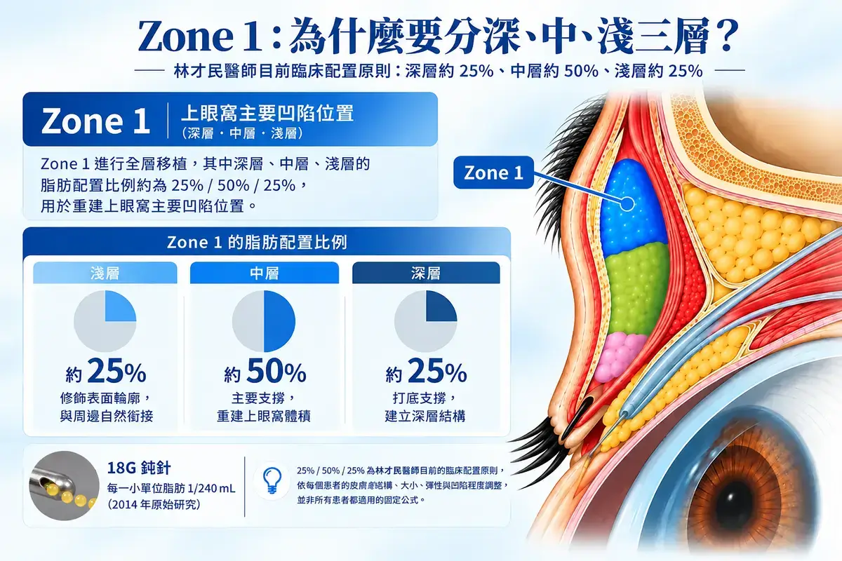 Zone 1 上眼窩脂肪移植深層、中層與淺層配置示意，林才民醫師目前臨床配置原則約為25%、50%、25%