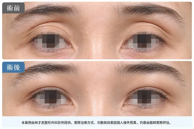 上眼窩凹陷脂肪移植術前術後案例，呈現上眼窩輪廓與眼褶外觀的前後差異