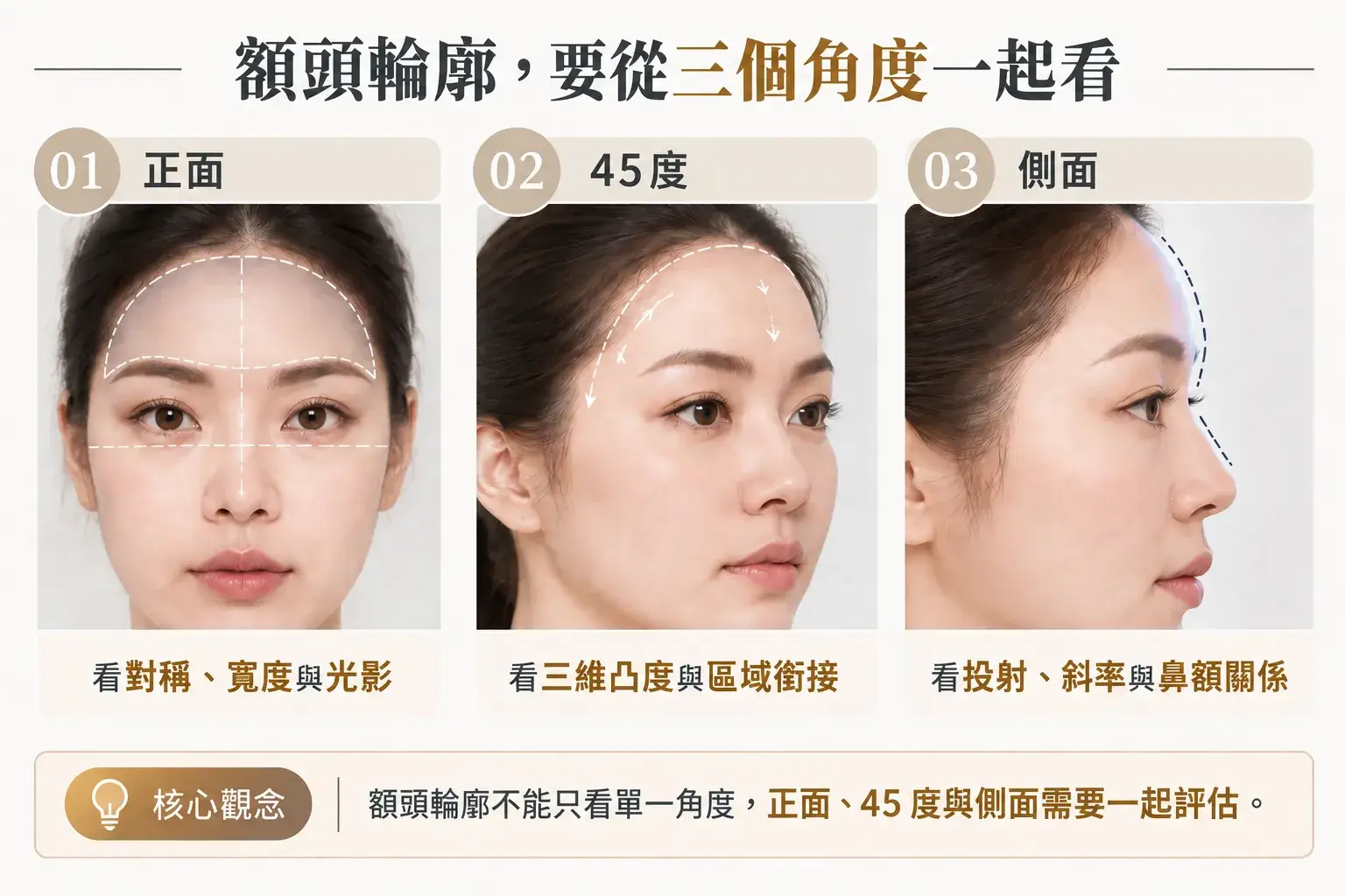額頭脂肪移植三角度評估示意,從正面觀察對稱、寬度與光影,45 度觀察三維凸度與區域銜接,側面觀察額頭向前的投射程度、斜率與鼻額關係