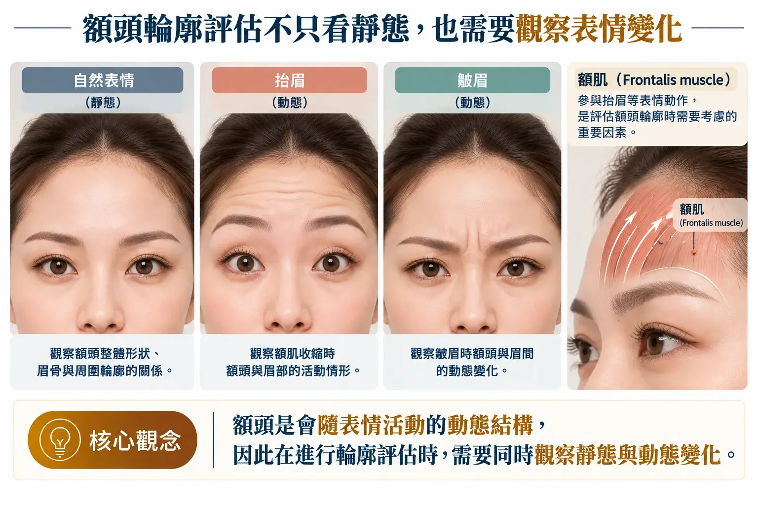 額頭脂肪移植靜態與動態評估示意,比較自然表情、抬眉與皺眉時的額頭及眉部變化,並說明額肌參與表情活動