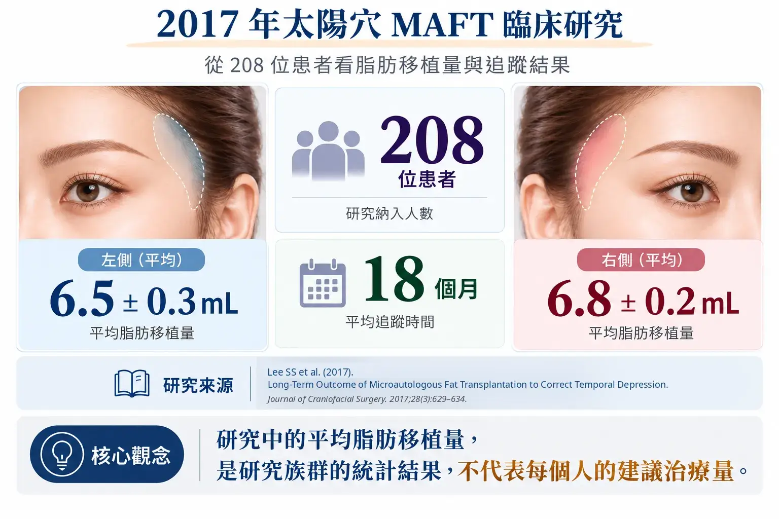 2017 年太陽穴 MAFT 臨床研究資訊圖,208 位患者右側平均脂肪移植量 6.8 ± 0.2 mL、左側 6.5 ± 0.3 mL,平均追蹤 18 個月